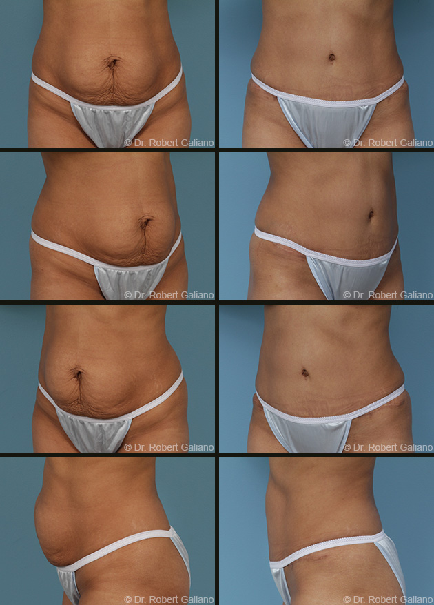 Chicago Tummy Tuck Before & After  Abdominoplasty Surgery Photos